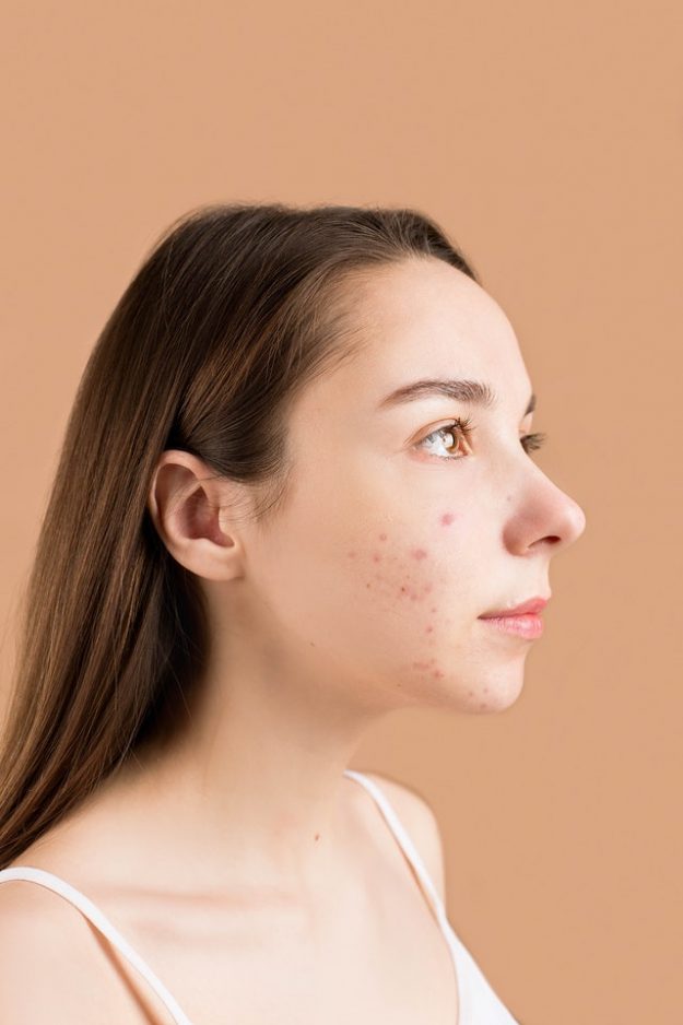 microneedling acne littekens