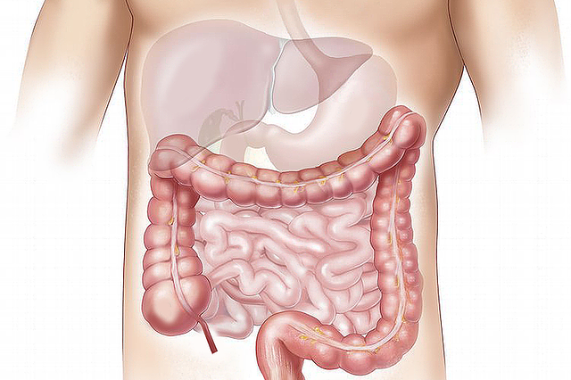 ziekte van crohn ziekte van crohn