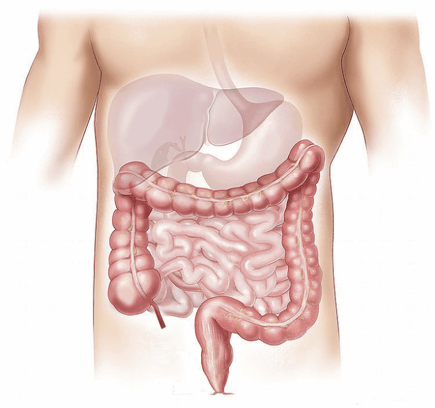 ziekte van crohn