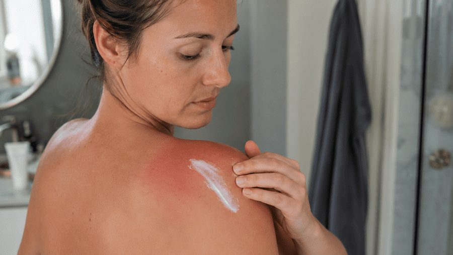 vrouw die verbrande huid insmeert met lotion